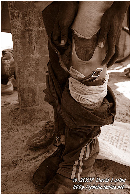 Putting On The Pegleg After Training - Amputee Football Team, Sierra Leone